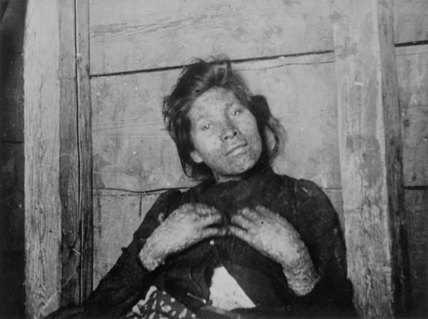 A woman with smallpox on Prince Edward Island in 1909. 